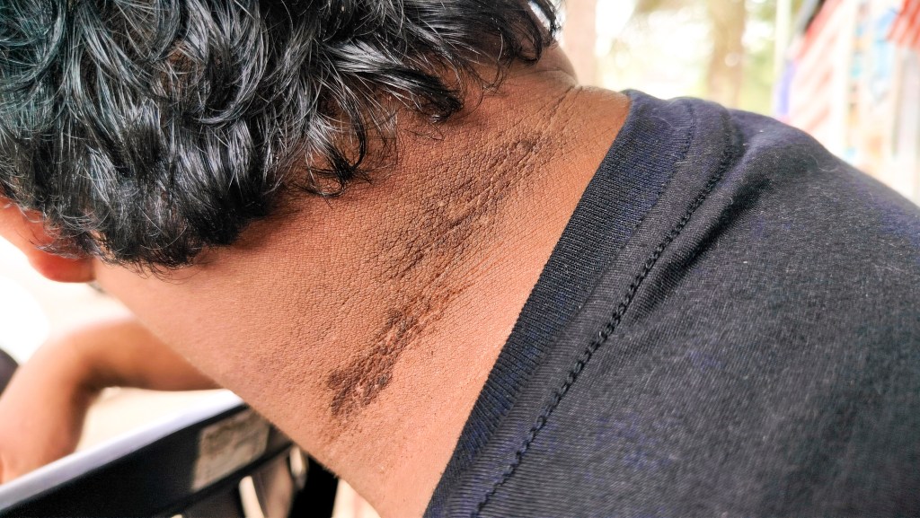 Acanthosis nigricans often affects people who are obese, and in rare cases, it can mean cancer.